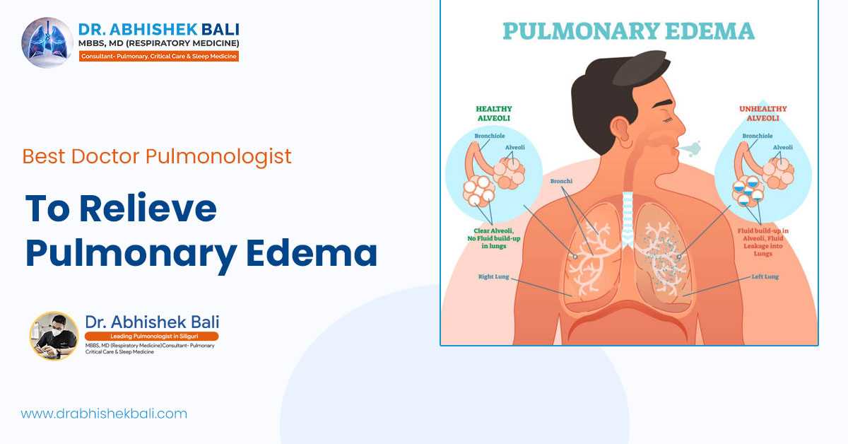 Best Doctor Pulmonologist To Relieve Pulmonary Edema