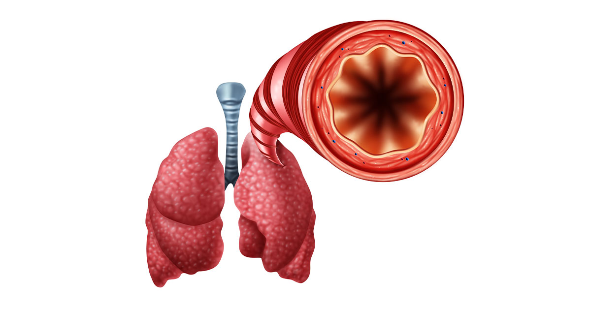 Inflammation of Bronchial Tubes 