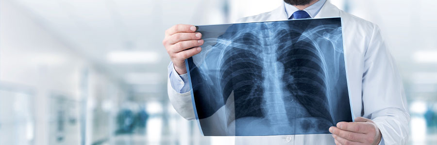 Chest X-Ray