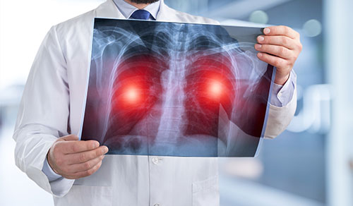 Transbronchial Lung Cryobiopsy