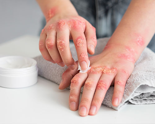 Fungal Lung Infections