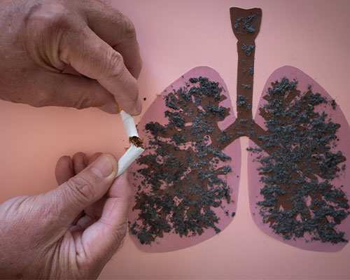 Interstitial Lung Disease