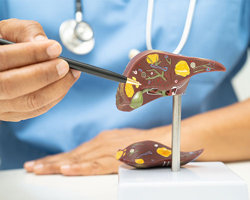 Liver Cirrhosis