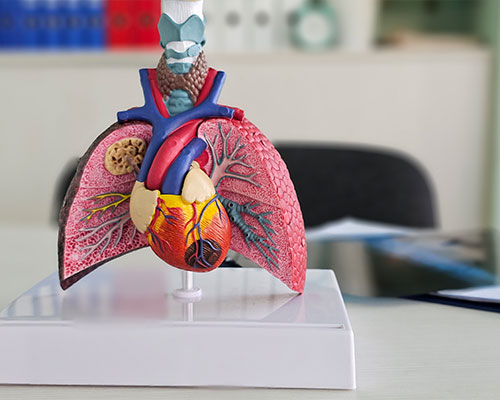 Pulmonary Embolism