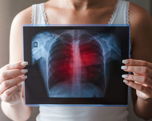 Viral Lung Infections